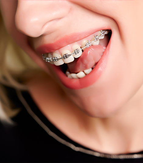 braces1